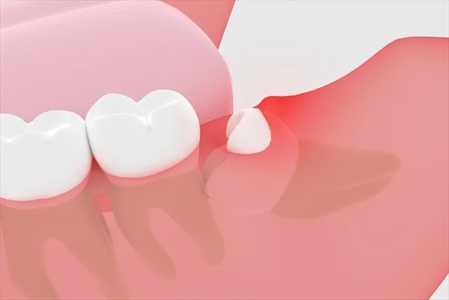 親知らず|藤沢の歯医者ならDiva Dental Clinic 藤沢駅前歯科